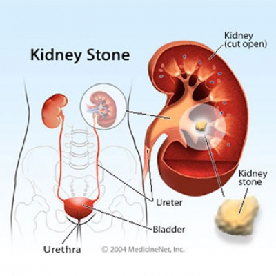 गुर्दे की पथरी (Kidney Stone)