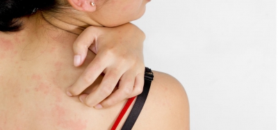 घमौरियां (Prickly Heat)