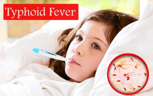 Typhoid Fever (टाइफाइड बुखार) का निदान